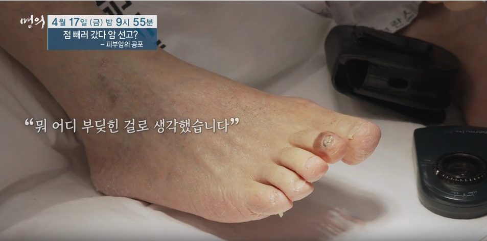 명의 피부암 점 구별법