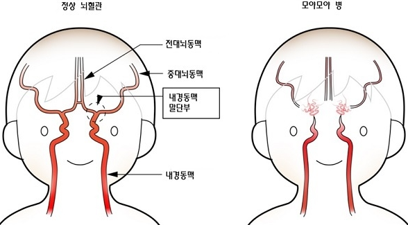 모야모야병 증상
