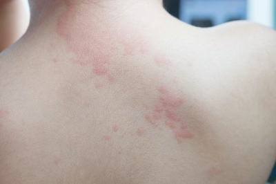 대상포진 초기증상