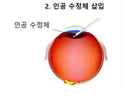 백내장 수술