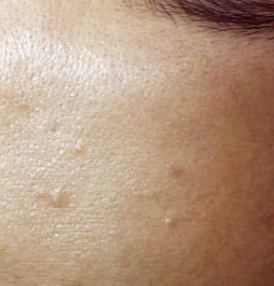 사마귀 원인과 제거방법