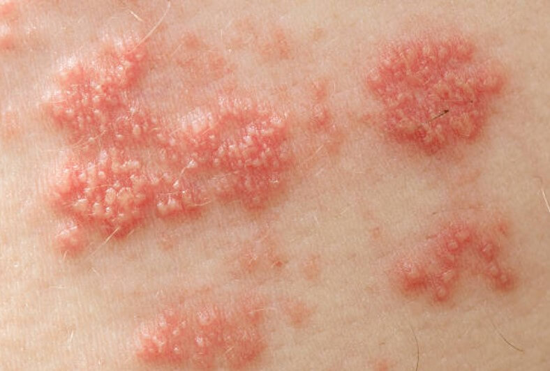 대상포진 초기증상 대상포진 조기치료 대상포진 초기증상 및 조기치료