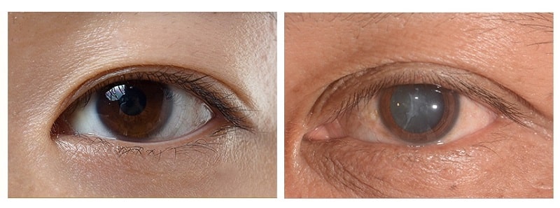 정상적인 수정체와 백내장 수정체 비교