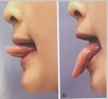 코골이에방운동3