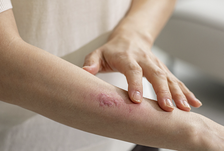 팔에 대상포진이 발생한 이미지