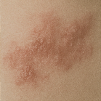 대상포진 증상, 바이러스 감염, 피부 질환