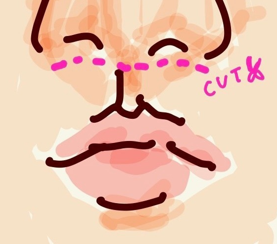 인중 축소 수술 후기