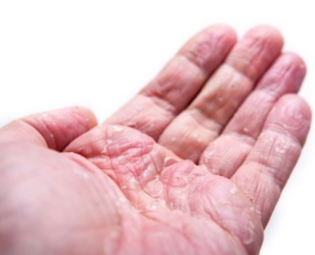 습진으로 허물이 벗겨진 손바닥 사진