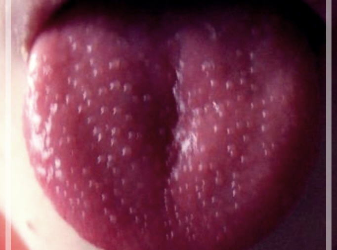 딸기혀 질병일명 가와사키병 원인 증상 치료에 모든 정보