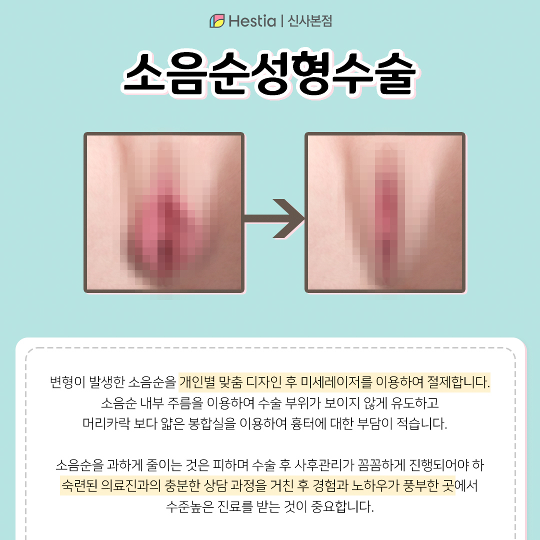근본적인 치료 : 소음순성형수술