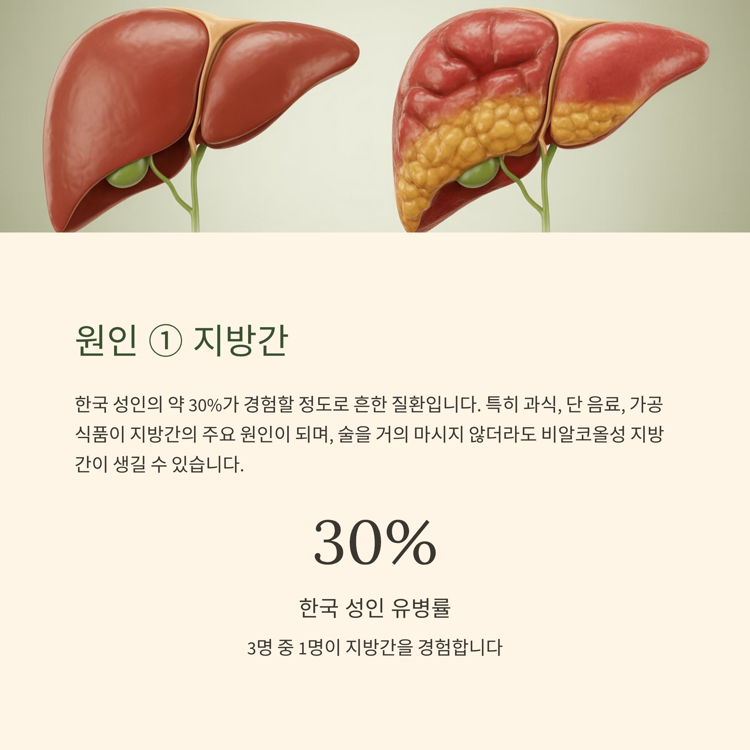 지방간