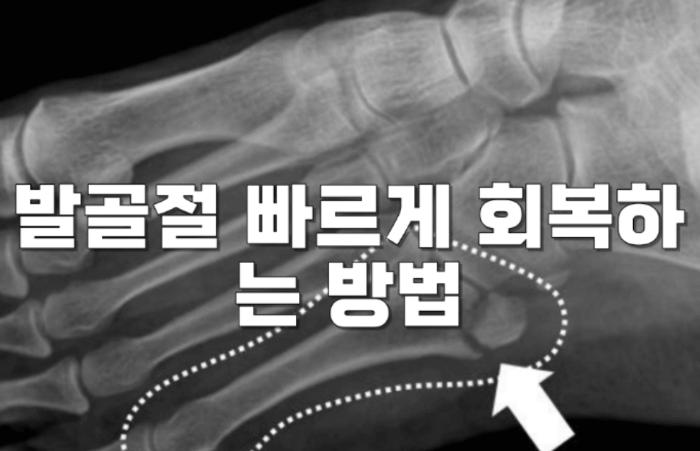 발골절 치료와 관리