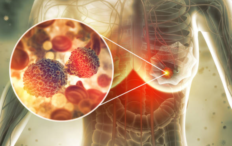 유방암과 관련된 사진2