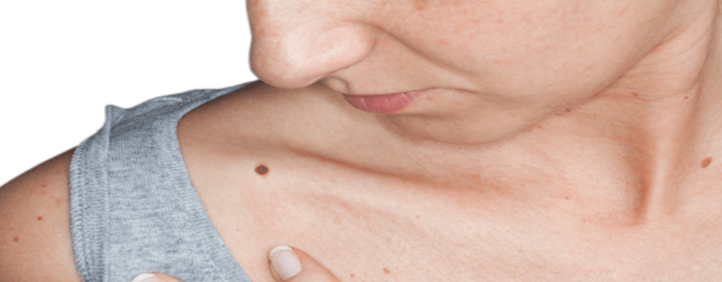 굵고 긴 털이 나는 점 예시