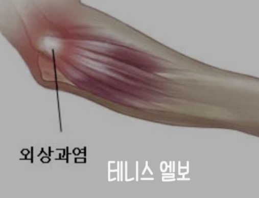 한국인에게 흔한 팔꿈치 통증 원인에 대한 사지s