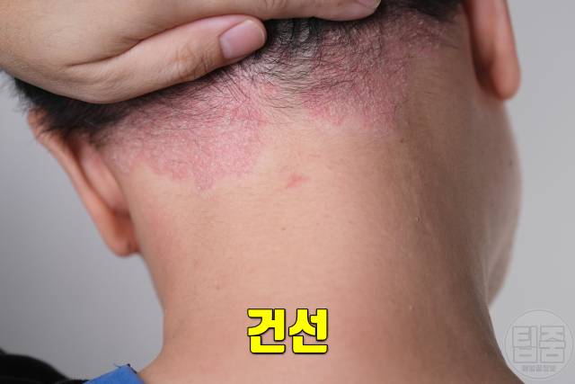 얼굴 붉은기 원인 얼굴 빨개지는 이유 얼굴홍조 원인 건선