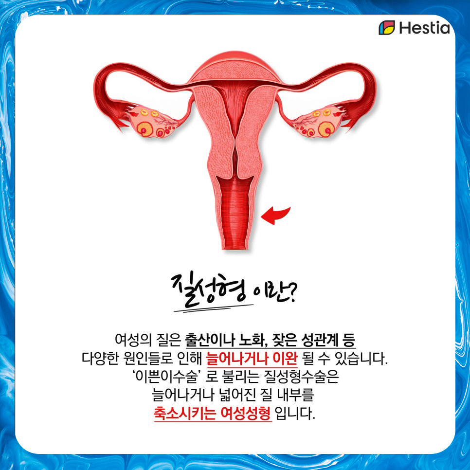 질성형이란
예쁘니수술이란?