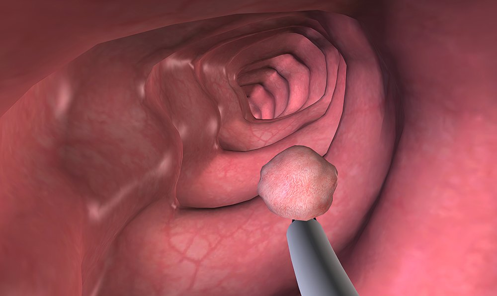 대장암 초기증상