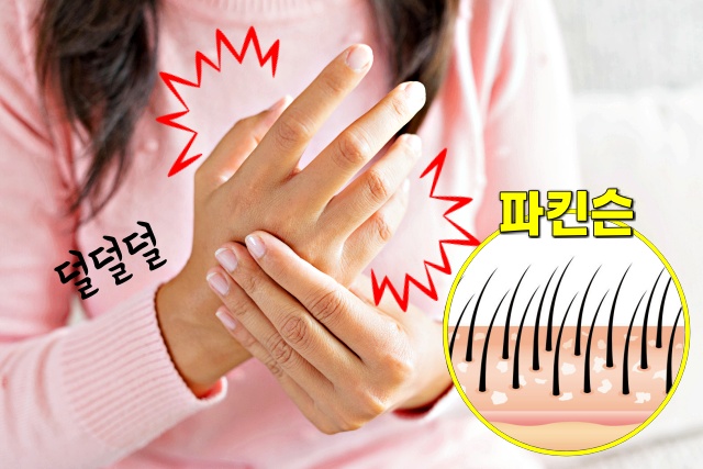 비듬이 생기는 원인 5가지 파킨슨병 당뇨, 건강 팁줌 매일꿀정보