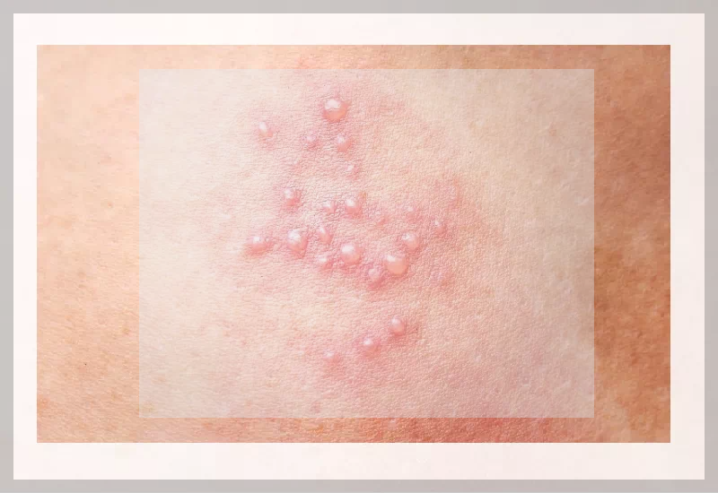 대상포진 수포형성