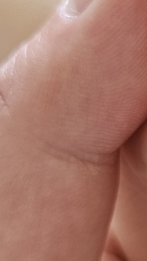 수족구병 증상 격리기간