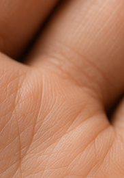 한포진 치료방법