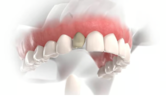 앞니 임플란트 시술과정