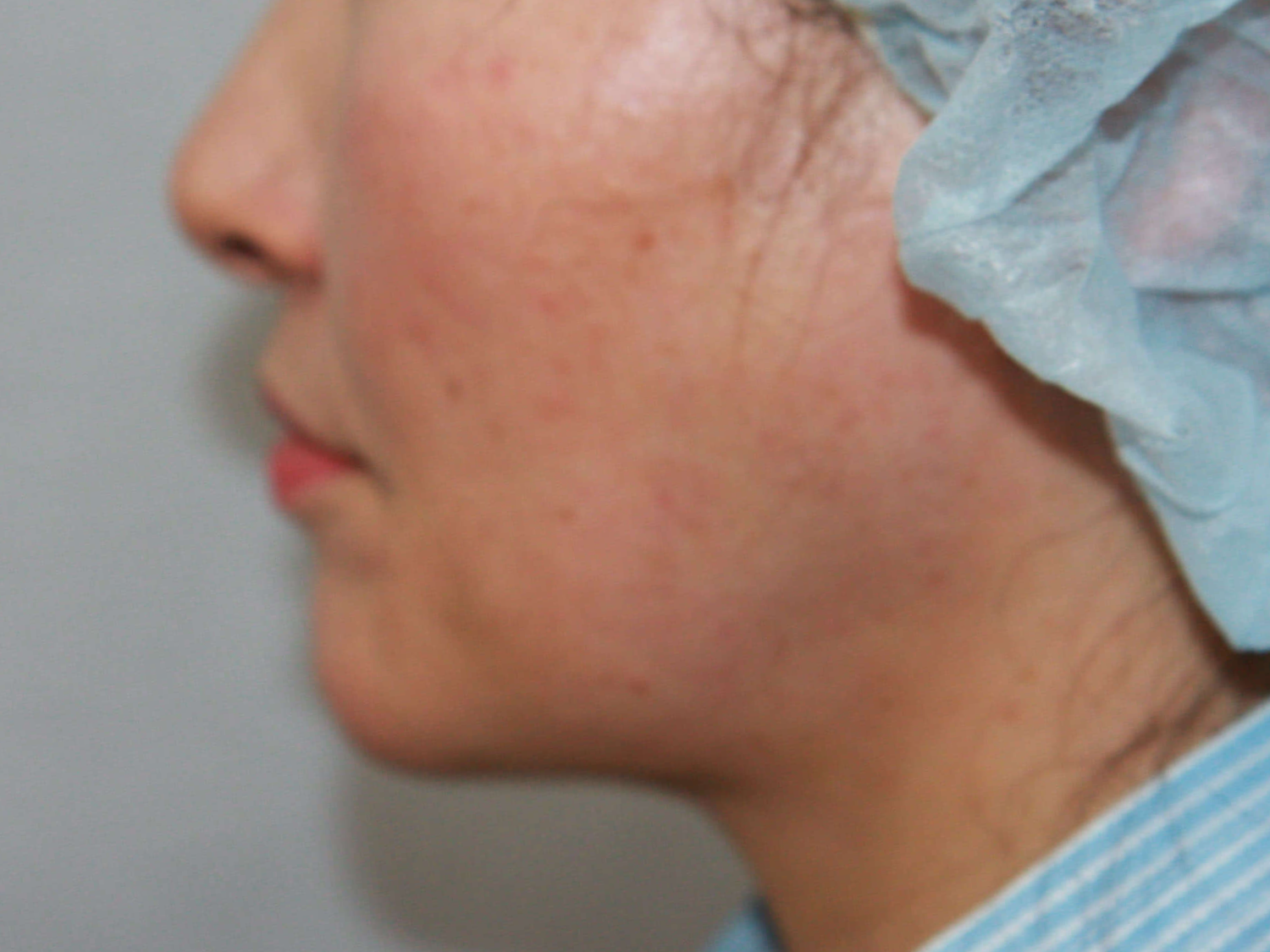 얼굴지방흡입-지방이식