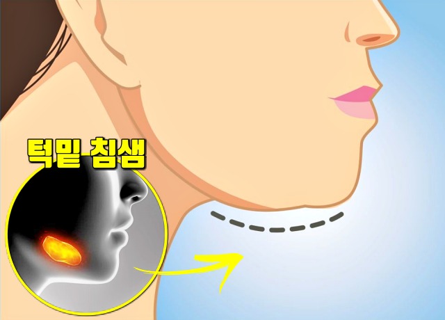다이어트,턱살,턱밑살,이중턱,사각턱,턱선,턱밑이 붓는 이유,침샘 비대증,건강 팁줌 매일꿀정보