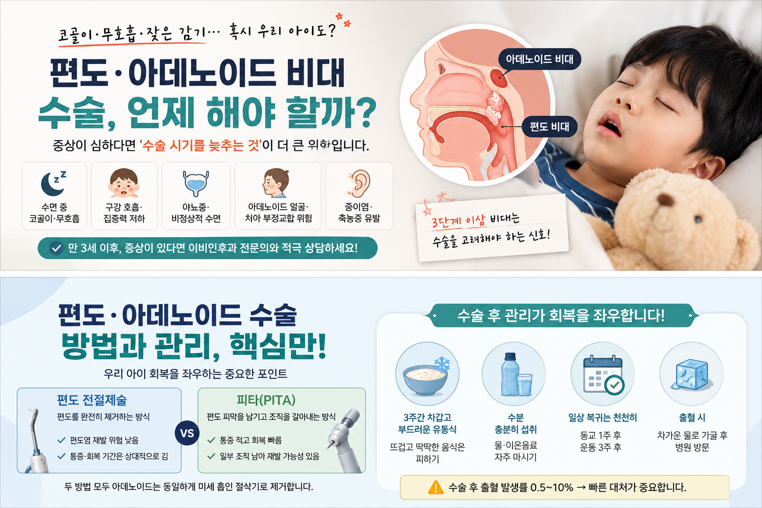 편도 아데노이드