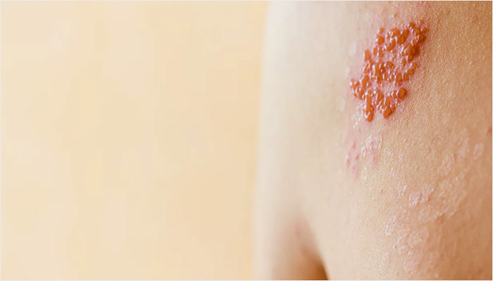 대상포진 초기증상중 하나는 붉은 발진과 물집