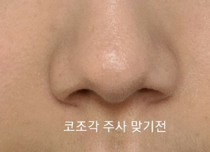 코조각주사 후기