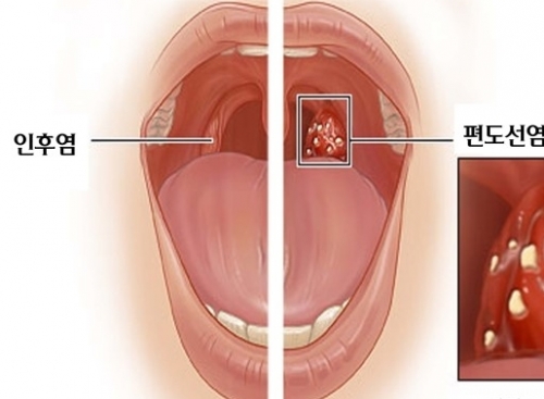 편도선염-질환-대처요령-자연요법