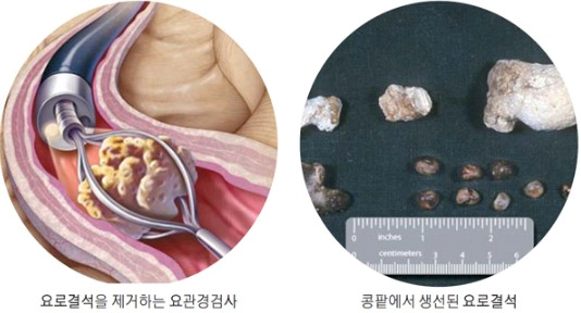 체외충격파쇄석술 비용