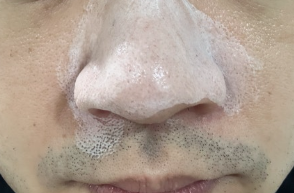 니프달 블랙헤드 내돈내산