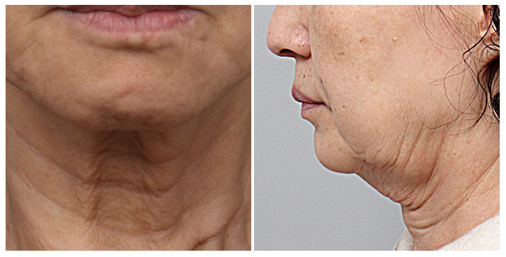 인천성형외과 목주름리프팅