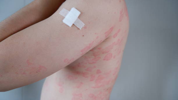 알레르기성 두드러기에 안전한 보습 성분 TOP 5