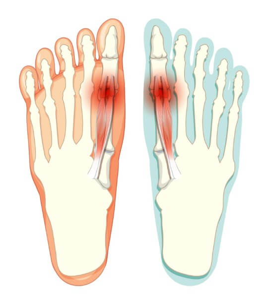 엄지발가락 영향