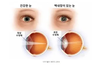 백내장 수술 비용 실비 보험 청구 회복기간_8