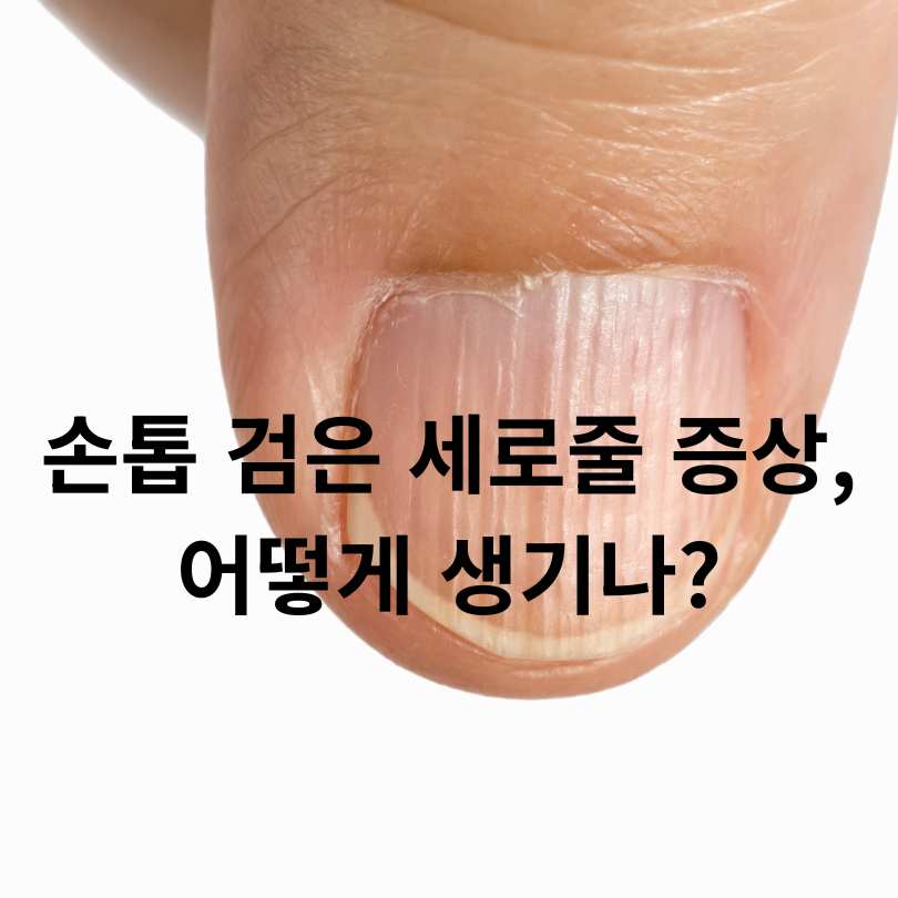 손톱에 검은 줄 증상,원인,치료법