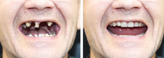 임플란트 시술과정