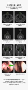 비염코막힘