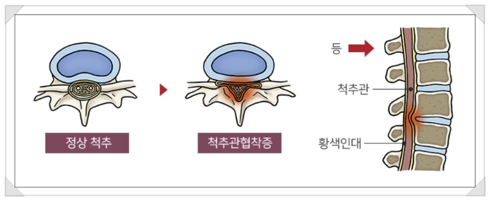 척추관 협착증