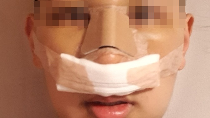 비중격 만곡증 수술 후기