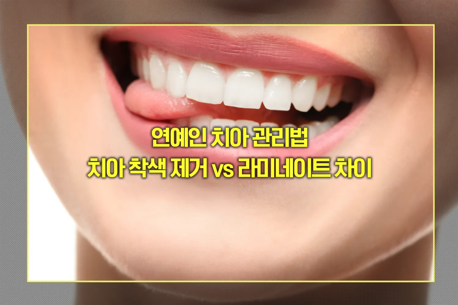 치아 착색 제거 vs 라미네이트 차이