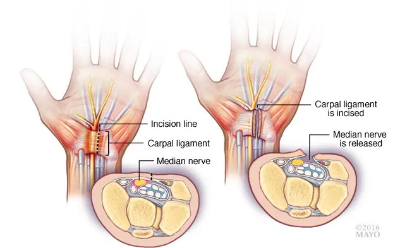 수근관증후군-손목터널증후군-carpaltunnelsyndrome