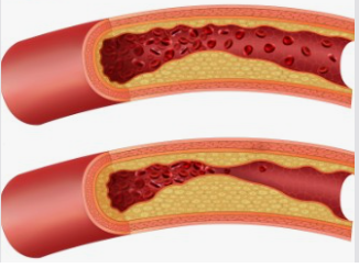 고지혈증 이미지