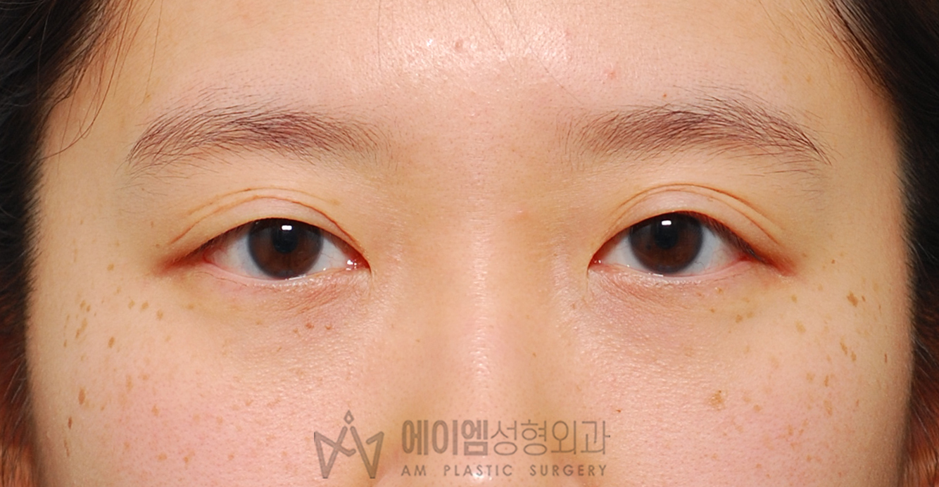 쌍꺼풀 풀림 수술 전