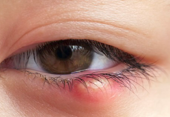 다래끼-초기증상