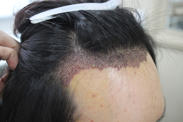 비절개모발이식후기